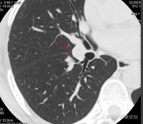 【病例】粘液型肺腺癌3例CT影像表现与分析 【病例】粘液型肺腺癌3例CT影像表现与分析