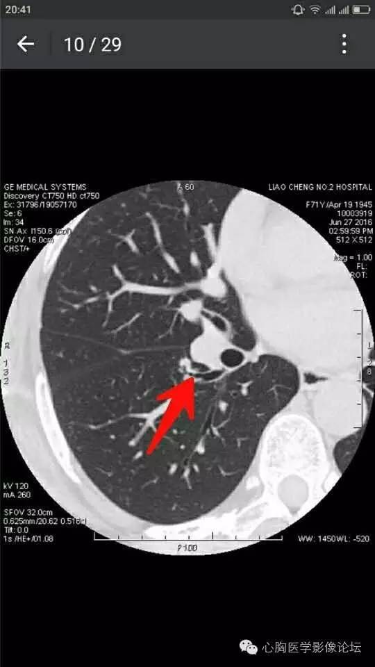 【病例】粘液型肺腺癌3例CT影像表现与分析 【病例】粘液型肺腺癌3例CT影像表现与分析