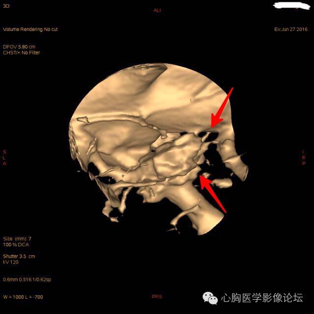 【病例】粘液型肺腺癌3例CT影像表现与分析 【病例】粘液型肺腺癌3例CT影像表现与分析