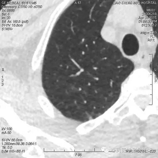 【病例】粘液型肺腺癌3例CT影像表现与分析 【病例】粘液型肺腺癌3例CT影像表现与分析