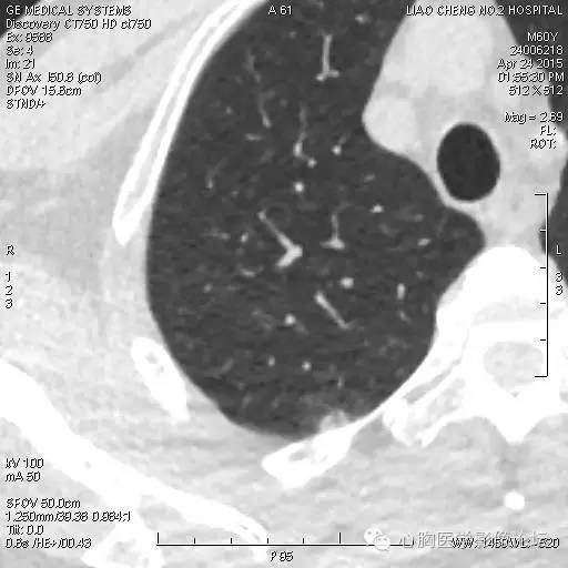 【病例】粘液型肺腺癌3例CT影像表现与分析 【病例】粘液型肺腺癌3例CT影像表现与分析