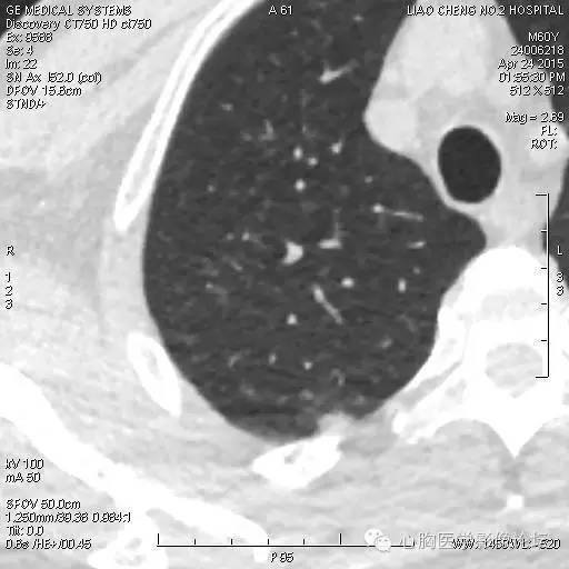 【病例】粘液型肺腺癌3例CT影像表现与分析 【病例】粘液型肺腺癌3例CT影像表现与分析