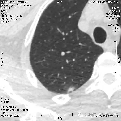 【病例】粘液型肺腺癌3例CT影像表现与分析 【病例】粘液型肺腺癌3例CT影像表现与分析