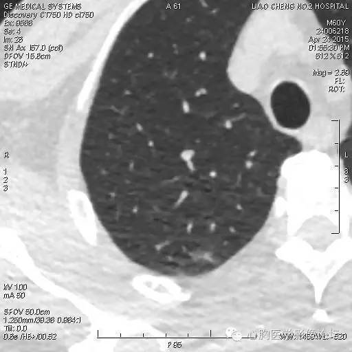 【病例】粘液型肺腺癌3例CT影像表现与分析 【病例】粘液型肺腺癌3例CT影像表现与分析