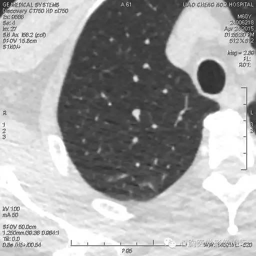 【病例】粘液型肺腺癌3例CT影像表现与分析 【病例】粘液型肺腺癌3例CT影像表现与分析