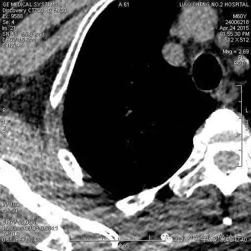 【病例】粘液型肺腺癌3例CT影像表现与分析 【病例】粘液型肺腺癌3例CT影像表现与分析