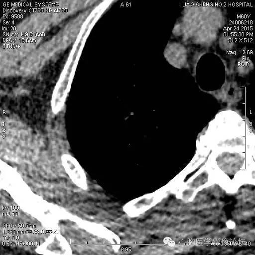 【病例】粘液型肺腺癌3例CT影像表现与分析 【病例】粘液型肺腺癌3例CT影像表现与分析