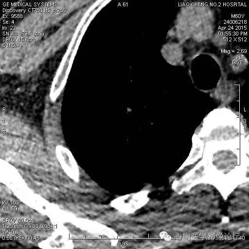 【病例】粘液型肺腺癌3例CT影像表现与分析 【病例】粘液型肺腺癌3例CT影像表现与分析