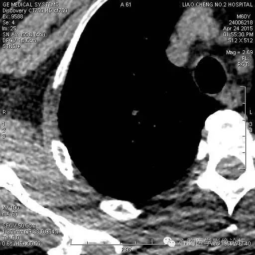 【病例】粘液型肺腺癌3例CT影像表现与分析 【病例】粘液型肺腺癌3例CT影像表现与分析