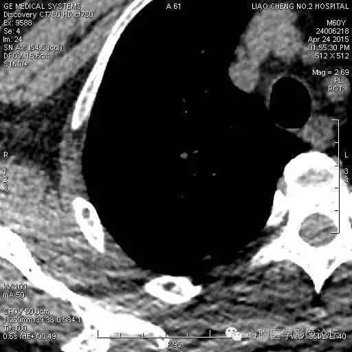 【病例】粘液型肺腺癌3例CT影像表现与分析 【病例】粘液型肺腺癌3例CT影像表现与分析