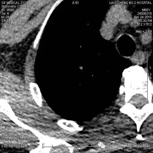 【病例】粘液型肺腺癌3例CT影像表现与分析 【病例】粘液型肺腺癌3例CT影像表现与分析