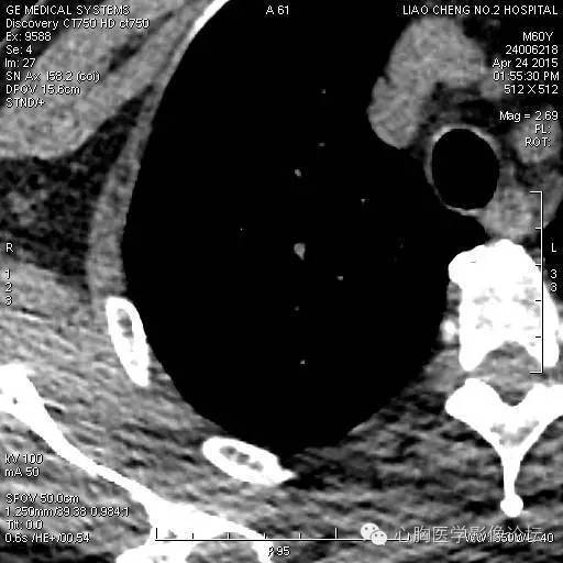 【病例】粘液型肺腺癌3例CT影像表现与分析 【病例】粘液型肺腺癌3例CT影像表现与分析