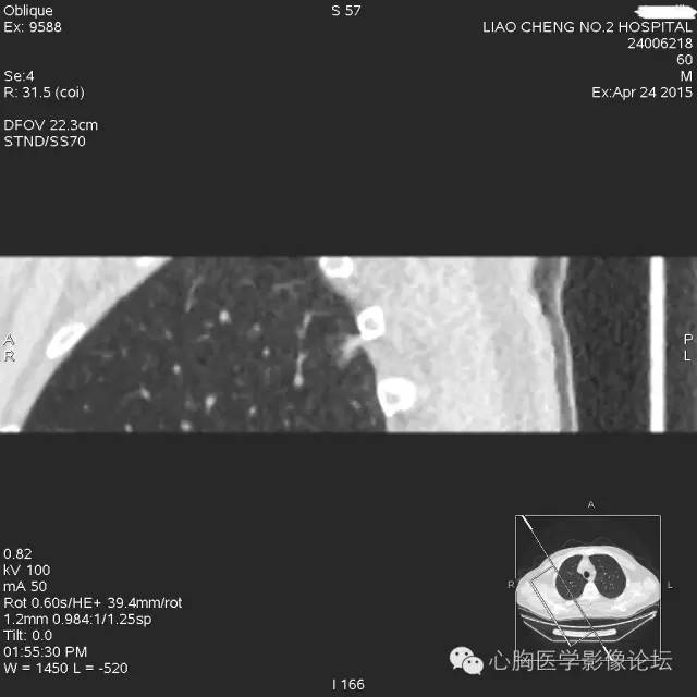 【病例】粘液型肺腺癌3例CT影像表现与分析 【病例】粘液型肺腺癌3例CT影像表现与分析
