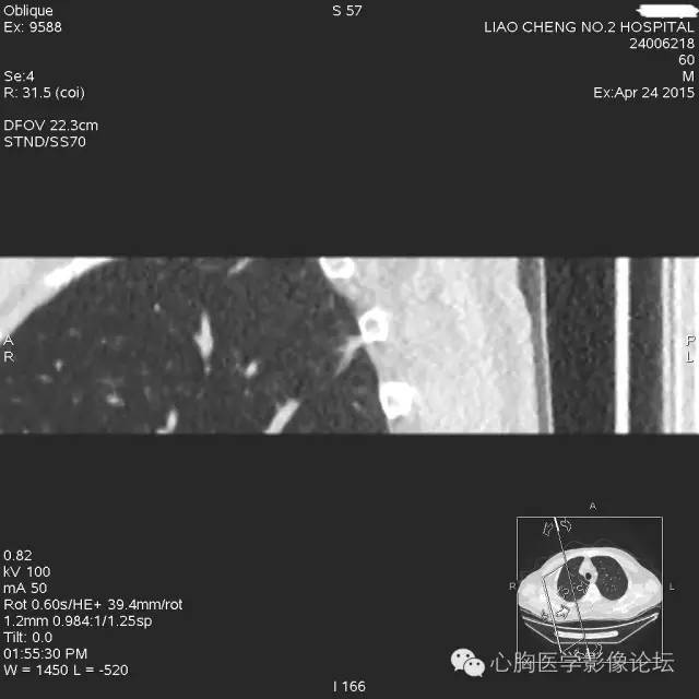 【病例】粘液型肺腺癌3例CT影像表现与分析 【病例】粘液型肺腺癌3例CT影像表现与分析