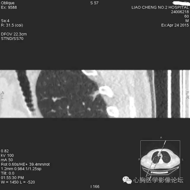 【病例】粘液型肺腺癌3例CT影像表现与分析 【病例】粘液型肺腺癌3例CT影像表现与分析