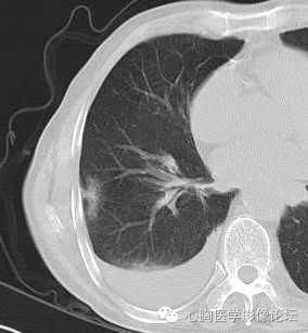 【病例】粘液型肺腺癌3例CT影像表现与分析 【病例】粘液型肺腺癌3例CT影像表现与分析