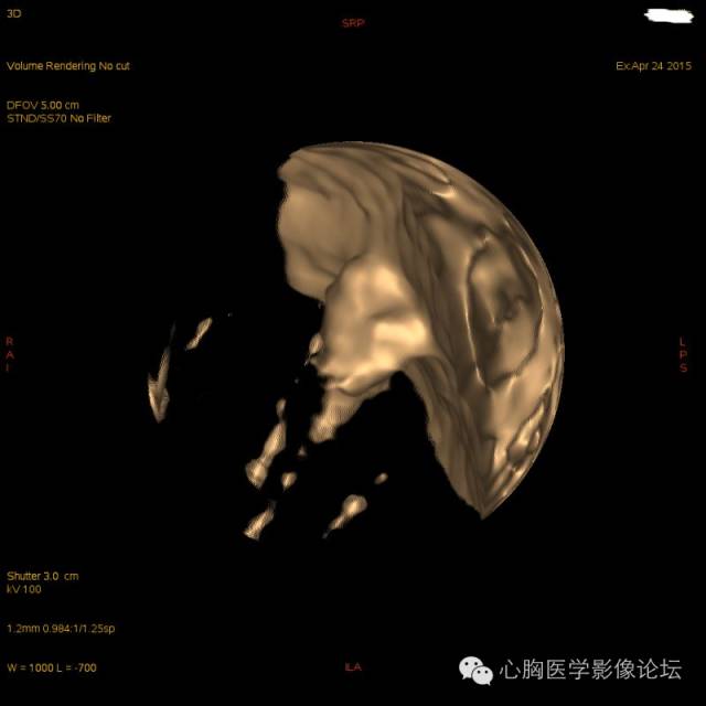 【病例】粘液型肺腺癌3例CT影像表现与分析 【病例】粘液型肺腺癌3例CT影像表现与分析