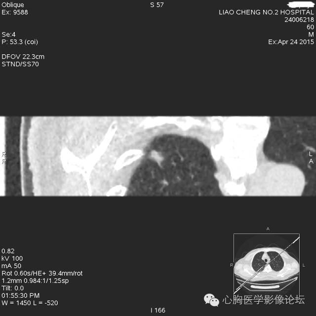【病例】粘液型肺腺癌3例CT影像表现与分析 【病例】粘液型肺腺癌3例CT影像表现与分析