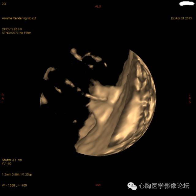 【病例】粘液型肺腺癌3例CT影像表现与分析 【病例】粘液型肺腺癌3例CT影像表现与分析