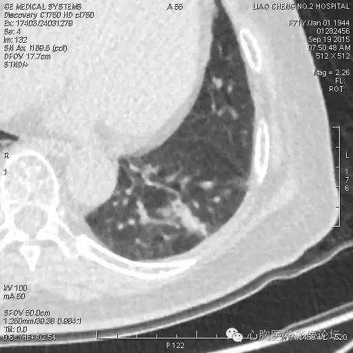 【病例】粘液型肺腺癌3例CT影像表现与分析 【病例】粘液型肺腺癌3例CT影像表现与分析