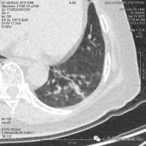 【病例】粘液型肺腺癌3例CT影像表现与分析 【病例】粘液型肺腺癌3例CT影像表现与分析