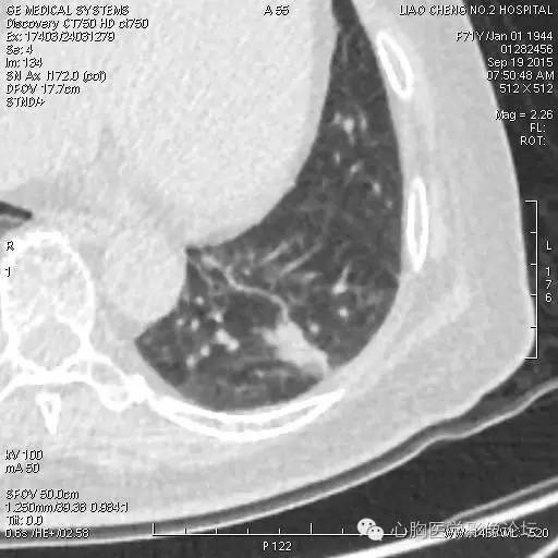 【病例】粘液型肺腺癌3例CT影像表现与分析 【病例】粘液型肺腺癌3例CT影像表现与分析