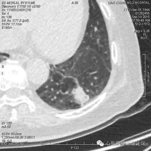 【病例】粘液型肺腺癌3例CT影像表现与分析 【病例】粘液型肺腺癌3例CT影像表现与分析