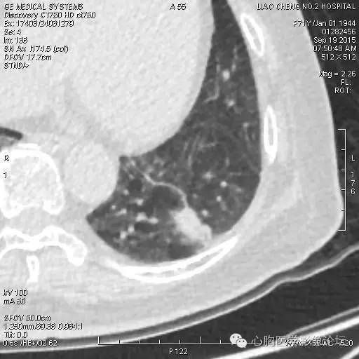【病例】粘液型肺腺癌3例CT影像表现与分析 【病例】粘液型肺腺癌3例CT影像表现与分析