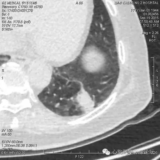 【病例】粘液型肺腺癌3例CT影像表现与分析 【病例】粘液型肺腺癌3例CT影像表现与分析