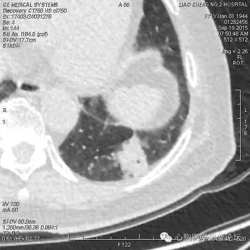 【病例】粘液型肺腺癌3例CT影像表现与分析 【病例】粘液型肺腺癌3例CT影像表现与分析