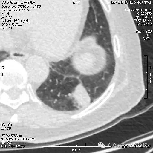 【病例】粘液型肺腺癌3例CT影像表现与分析 【病例】粘液型肺腺癌3例CT影像表现与分析
