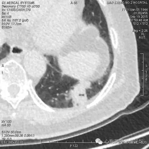 【病例】粘液型肺腺癌3例CT影像表现与分析 【病例】粘液型肺腺癌3例CT影像表现与分析