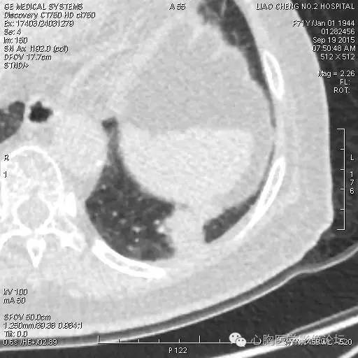 【病例】粘液型肺腺癌3例CT影像表现与分析 【病例】粘液型肺腺癌3例CT影像表现与分析