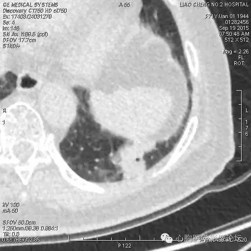 【病例】粘液型肺腺癌3例CT影像表现与分析 【病例】粘液型肺腺癌3例CT影像表现与分析