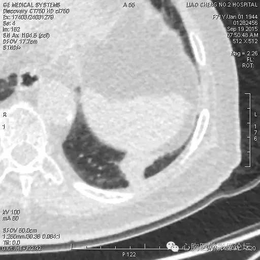 【病例】粘液型肺腺癌3例CT影像表现与分析 【病例】粘液型肺腺癌3例CT影像表现与分析