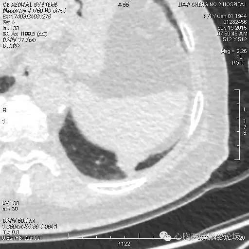 【病例】粘液型肺腺癌3例CT影像表现与分析 【病例】粘液型肺腺癌3例CT影像表现与分析