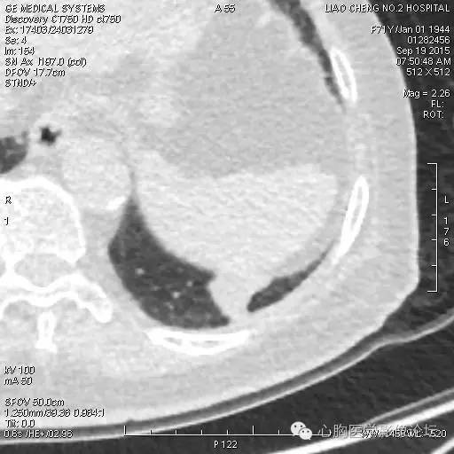 【病例】粘液型肺腺癌3例CT影像表现与分析 【病例】粘液型肺腺癌3例CT影像表现与分析