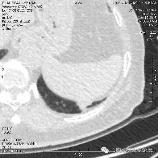 【病例】粘液型肺腺癌3例CT影像表现与分析 【病例】粘液型肺腺癌3例CT影像表现与分析
