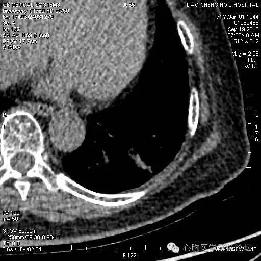 【病例】粘液型肺腺癌3例CT影像表现与分析 【病例】粘液型肺腺癌3例CT影像表现与分析