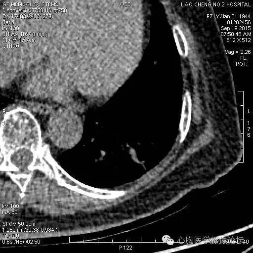 【病例】粘液型肺腺癌3例CT影像表现与分析 【病例】粘液型肺腺癌3例CT影像表现与分析