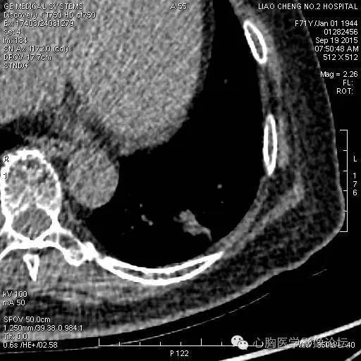 【病例】粘液型肺腺癌3例CT影像表现与分析 【病例】粘液型肺腺癌3例CT影像表现与分析