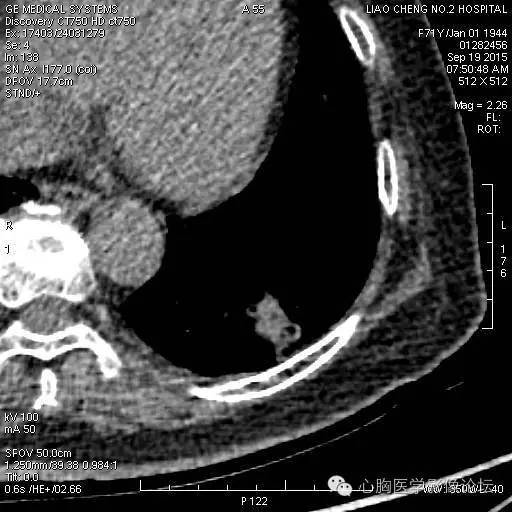 【病例】粘液型肺腺癌3例CT影像表现与分析 【病例】粘液型肺腺癌3例CT影像表现与分析