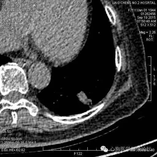 【病例】粘液型肺腺癌3例CT影像表现与分析 【病例】粘液型肺腺癌3例CT影像表现与分析