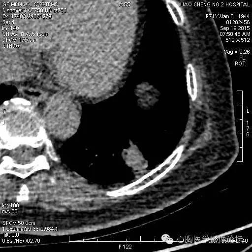【病例】粘液型肺腺癌3例CT影像表现与分析 【病例】粘液型肺腺癌3例CT影像表现与分析