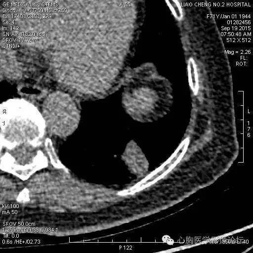 【病例】粘液型肺腺癌3例CT影像表现与分析 【病例】粘液型肺腺癌3例CT影像表现与分析