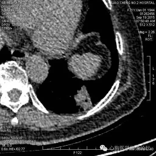 【病例】粘液型肺腺癌3例CT影像表现与分析 【病例】粘液型肺腺癌3例CT影像表现与分析