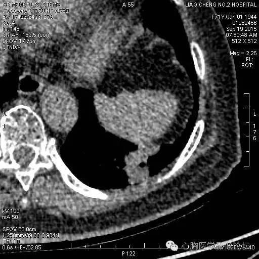 【病例】粘液型肺腺癌3例CT影像表现与分析 【病例】粘液型肺腺癌3例CT影像表现与分析