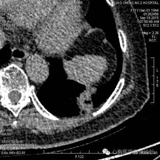 【病例】粘液型肺腺癌3例CT影像表现与分析 【病例】粘液型肺腺癌3例CT影像表现与分析