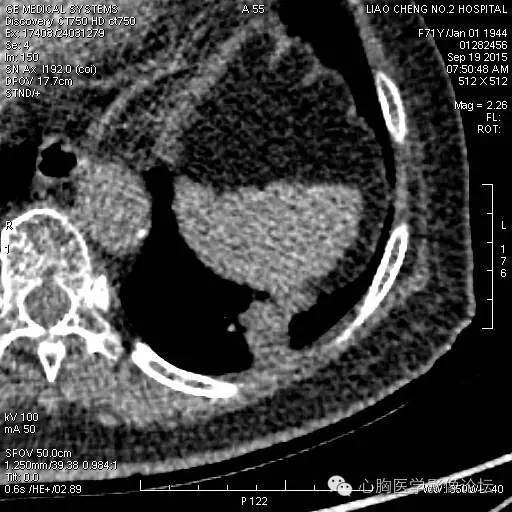 【病例】粘液型肺腺癌3例CT影像表现与分析 【病例】粘液型肺腺癌3例CT影像表现与分析