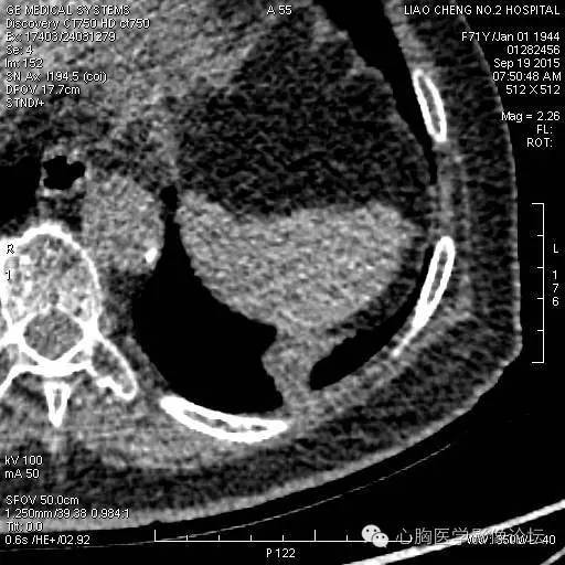 【病例】粘液型肺腺癌3例CT影像表现与分析 【病例】粘液型肺腺癌3例CT影像表现与分析